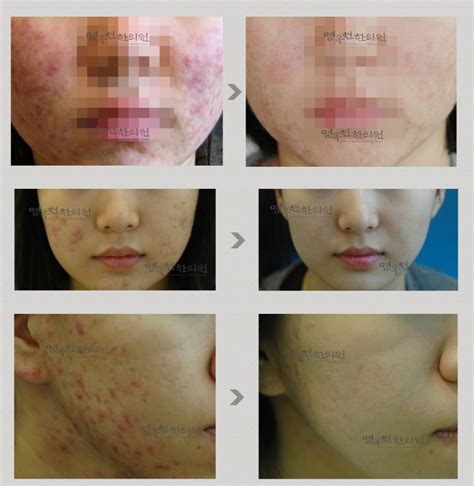 Acne Scar Treatment