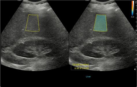 Ultrasound Based Hepatic Fat Quantification Current Status And Future