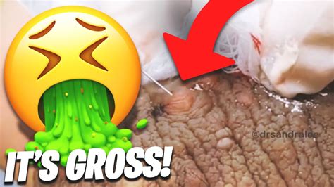 The Most DISGUSTING Pops Ever On Dr Pimple Popper YouTube