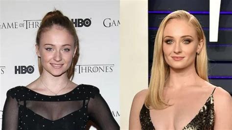 Did Sophie Turner Really Get Buccal Fat Removal Plastic Surgery Invest Records