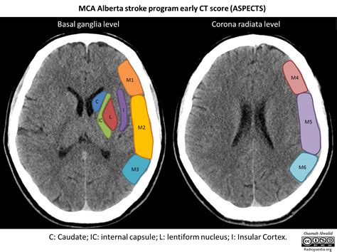 Posterior Circulation Ischaemic Stroke Imaging Correlates And