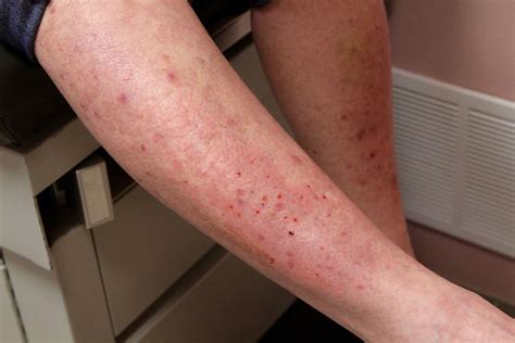 Dermatitis Herpetiformis Elbow