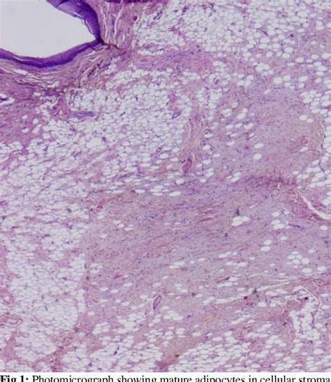 Figure 1 From Spindle Cell Lipoma Of The Buccal Mucosa A Case Report