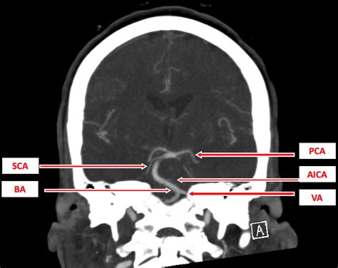 Basilar Artery Infarct Treatment Management Point Of Care