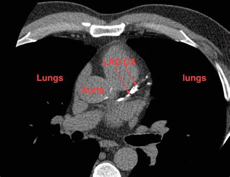 High Heart Calcium CT Scan Score: What to Do? Part 1: Joel Kahn, MD ...