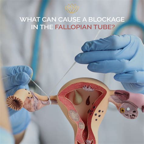 What Can Cause A Blockage In A Fallopian Tube Fibroid Treatment Clinic