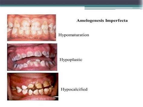 Dental Stain Introduction Types Causes Treatment Pptx