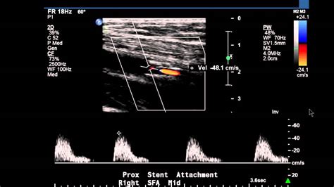 Lower Extremity Arterial Ultrasound Criteria