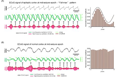 Ecog Signals Of Epileptic Cortex A And Normal Cortex B In The