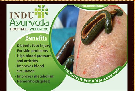 Leech Therapy In Ayurveda