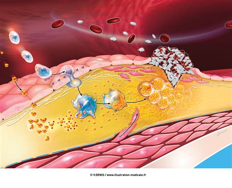 Formation d une plaque d athérome athérosclérose Illustration Médicale