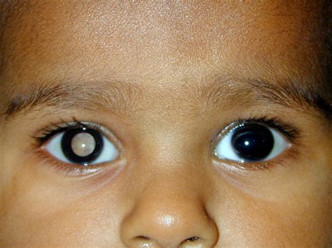 Retinoblastoma