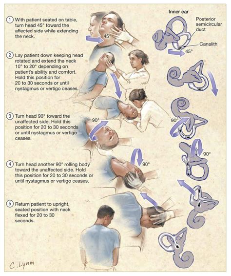 Management Of Benign Paroxysmal Positional Vertigo With The Canalith