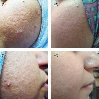 (a) Atrophic acne scars (Grade III) before treatment on the right side ...