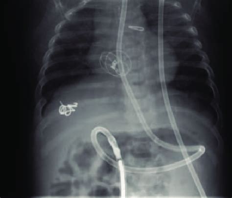 A Chest X Ray The Day After Closure Of The Atrial Septal Defect