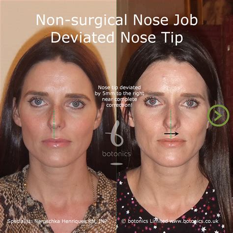 Non Surgical Nose Job Before And After Photos Comparison In London Uk