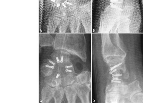 A D A Ap And B Lateral Radiographs Taken Immediate Postoperatively