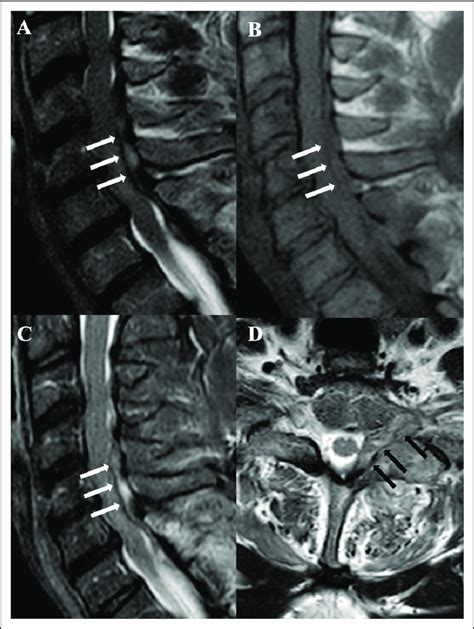 Sagittal TSE T2 A TSE T1 B STIR C And Axial Unenhanced TSE T1