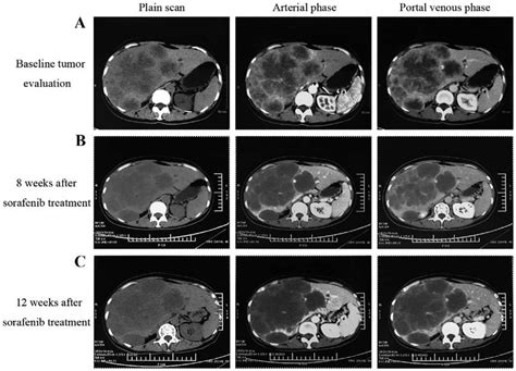 Radiological Tumor Evaluation Of A Patient With Intrahepatic