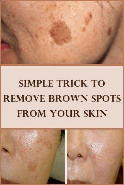 Remove Dark Spots On Your Face In Just 3 Nights Manchas No Rosto