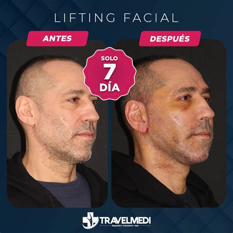 Lifting Facial En Turqu A Precios Antes Despu S