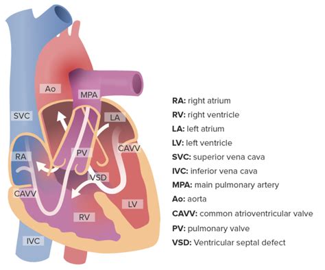 Atrioventricular Septal Defect Heart Defect Unbalanced