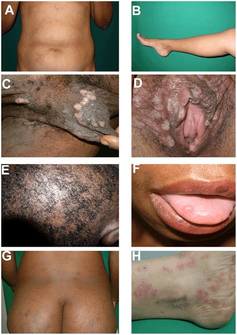 Mucosal And Cutaneous Lesions Of Secondary Syphilis Secondary Syphilis