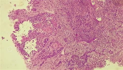 Photomicrograph of histological slide showing Lobular capillary hemangioma on finger. 43292122 ...