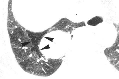 Intrapulmonary Bronchogenic Cyst Ct And Pathologic Findings In Five