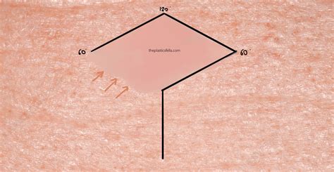 Rhomboid Flap - Indications, Design, Examples