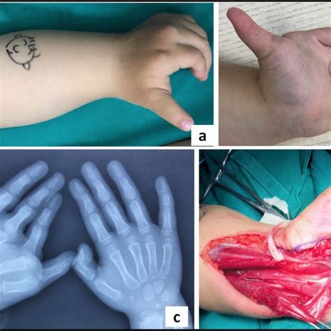 Patient C1 With Congenital Hypertrophy Of The Left Forearm And Left Download Scientific Diagram