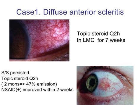 Scleritis Professor 1001030