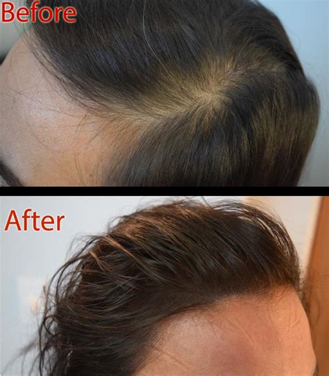 Female Hair Loss And Smp Dermimatch Hair Clinic Scalp