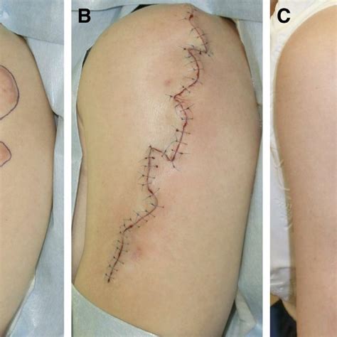 The Case Of A 46 Year Old Woman With An Upper Arm Keloid A Download Scientific Diagram