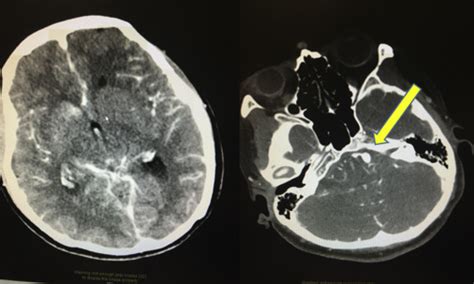 Neurogenic Stunned Myocardium A Case Report And Brief Review Journal