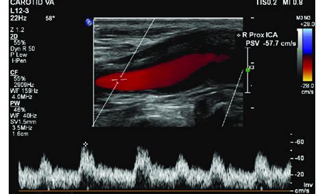 Follow Up Doppler Spectrum With Color Flow Image Of Right Proximal Download Scientific Diagram