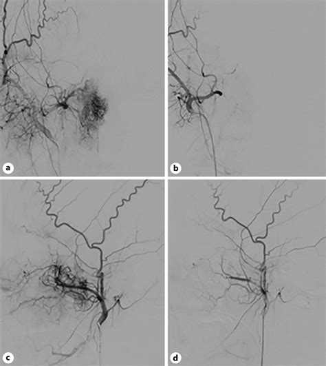 Ap A And Lateral C Digital Subtraction Angiographic Dsa Views Of Download Scientific