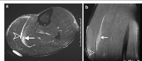 Calf Strain Mri