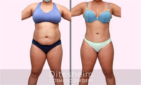 Tummy Tuck Flat Tummy Defined Waist And Lost One Year Later