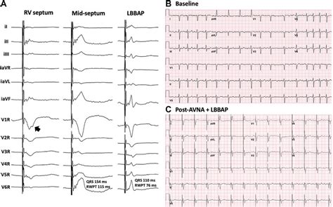 A Twelve Lead Electrocardiograms ECG With Inverted Limb Leads And