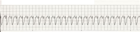 Float Nurse Acls Review Wide Complex Tachycardia Wct Part