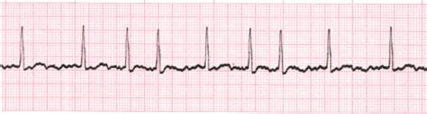 Basic ECG Arrhythmia Practice Test