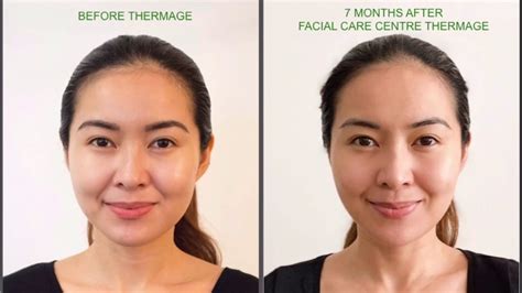 Facial Care Centre Thermage Experience Results Before And After