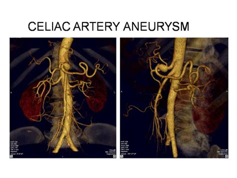 Celiac Artery