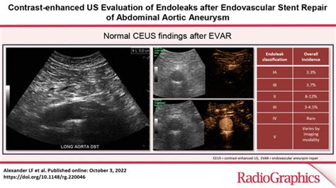 Contrast Enhanced Us Evaluation Of Endoleaks After Endovascular Stent Repair Of Abdominal Aortic