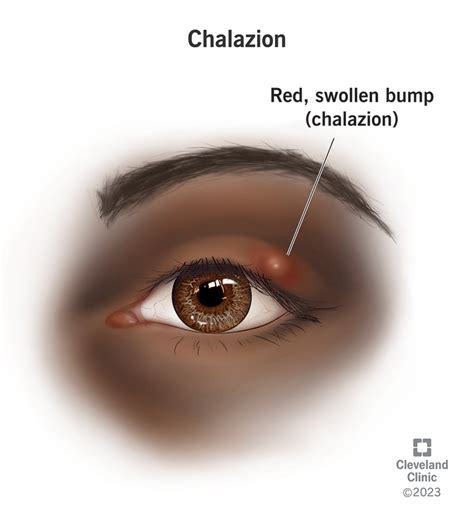 Chalazion Symptoms Causes Prevention And Treatments