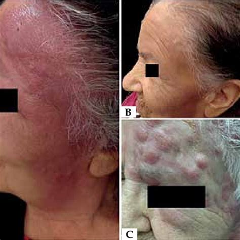 A Erythematous Violaceous Plaque B Full Remission Of The Lesion After