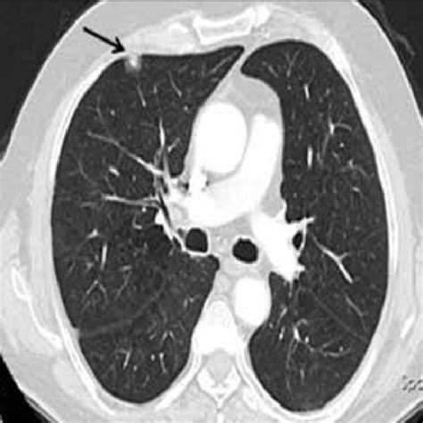 A 12 Mm Diameter Pulmonary Nodule With Subpleural Placement In The Download Scientific Diagram