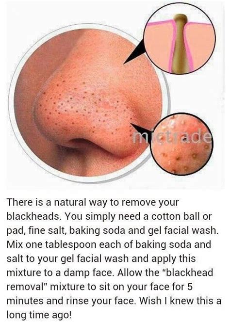 Untitled Tips To Get Rid Of Blackheads On Nose Fast