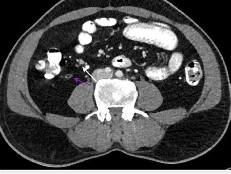 Contrast-enhanced CT abdomen axial view showing normal appendix with... | Download Scientific ...